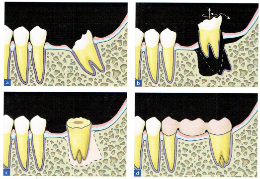 歯槽窩内移植(1)　外科的整直画像
