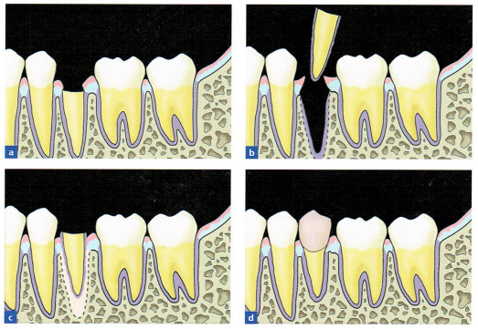 歯槽窩内移植(2)　外科的挺出画像