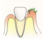 カビが歯ぐきについて根を下ろし炎症を起こします。