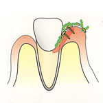 炎症によって歯ぐきが腫れ、歯と歯ぐきの間の溝が汚れやすくなり、カビがさらに奥で炎症を起こします。