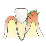 歯と歯ぐきの間にポケットができます。歯周ポケットといいます。ここに歯周病菌がたまり、炎症がひどくなり、骨が溶けていきます。