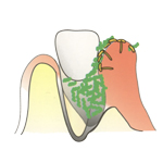 骨はさらに溶け歯周ポケットはさらに深くなり、さらに多くの菌がたまっていきます。