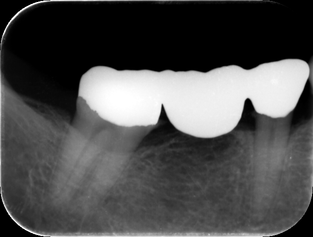 1歯欠損の補綴症例（ブリッジ）