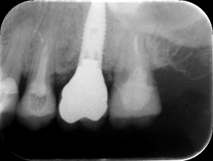1歯症例の補綴症例（インプラント）