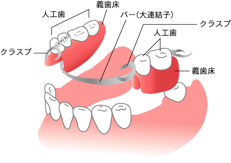 部分入れ歯（リムーバブル　パーシャルデンチャー）