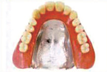 コバルト・クロム合金床義歯