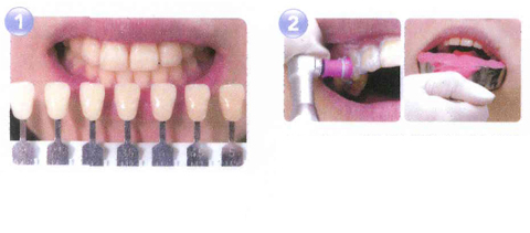 ホームホワイトニングのステップ1/2