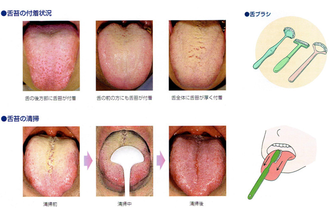 舌の清掃方法を教えてください。図