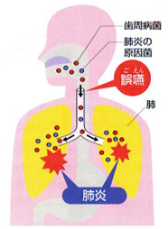 誤嚥性肺炎と歯周病の関係