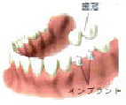 インプラントのほかの治療法1