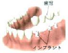 インプラントのほかの治療法2