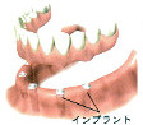 インプラントのほかの治療法3