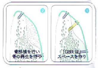 GBR法