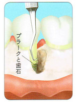 歯肉を切開し、歯石などの汚れや炎症におかされた歯周組織を取り除きます。