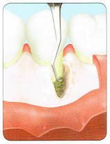 歯石やプラークや汚染された歯周組織を取り除きます。