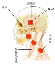 TMJのタイプ1 筋肉のトラブル