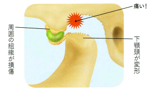 TMJのタイプ4 骨の変形のトラブル