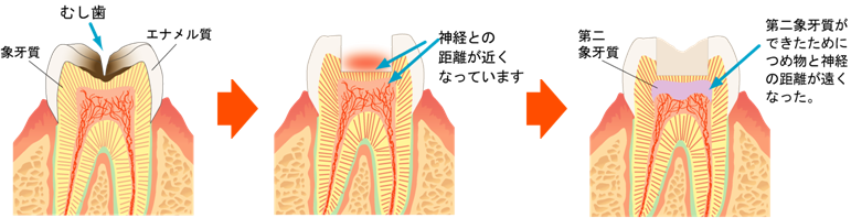 むし歯の進行と象牙質の関係