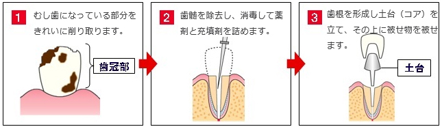 土台（コア）の治療プロセス