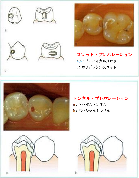 スロットプレパレーション・トンネルプレパレーション