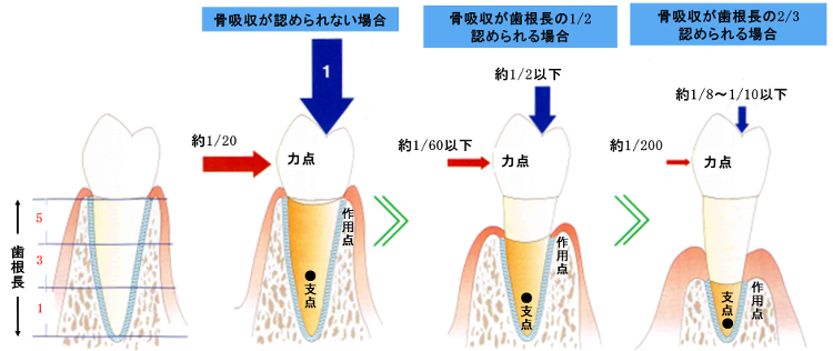 骨の吸収