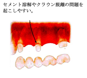 中間支台歯の負担