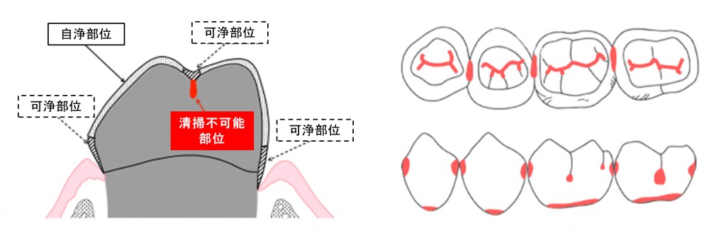 歯みがきの限界と日本人のむし歯好発部位