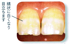 縞状に白くなり目立ちます