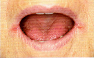 ドライマウスの症状3 カンジダ性口角炎