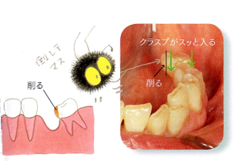 部分入れ歯時の注意2 歯が倒れている