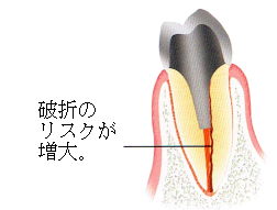 部分入れ歯時の注意4 支えにしたい歯に神経がない