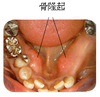 部分入れ歯時の注意5 骨隆起がある