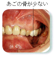 部分入れ歯時の注意6 あごの骨が少ない
