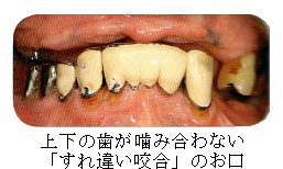 部分入れ歯時の注意7 噛み合う歯がない（すれ違い咬合）