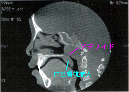 adenoid