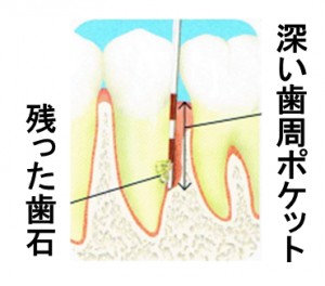 歯周外科治療の流れ1
