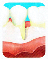 歯周外科治療の流れ3