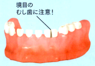 癒合歯