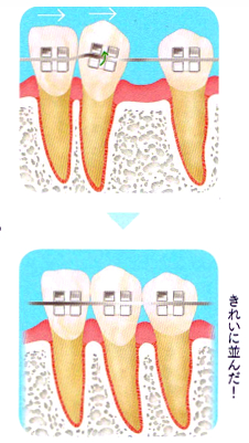 ワイヤーを使うときれいに並びます