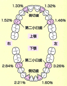 永久歯の先天性欠如：上下顎の発現率の割合が高い歯種を表した図