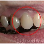 オールセラミック(セレック)