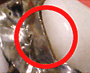 銀歯の詰め物　隙間