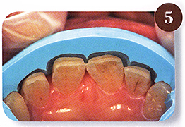 歯の形成