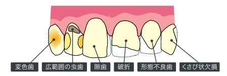 変色歯、広範囲の虫歯、隙歯、破折、形態不良歯、くさび状欠損
