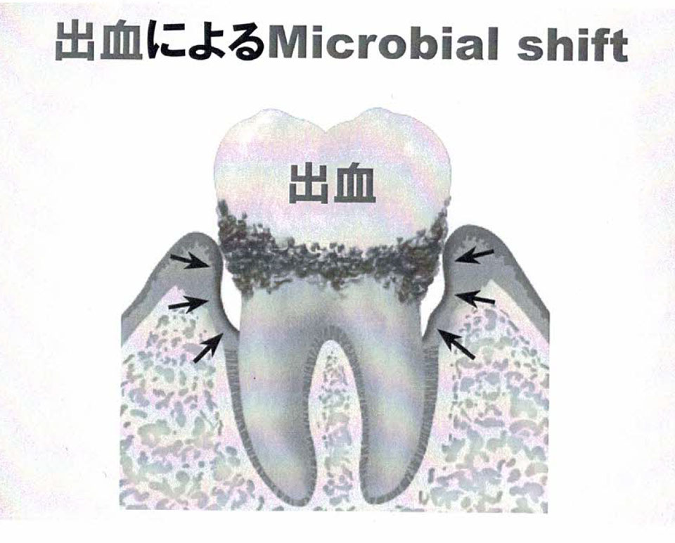 出血により、歯周病は悪化します